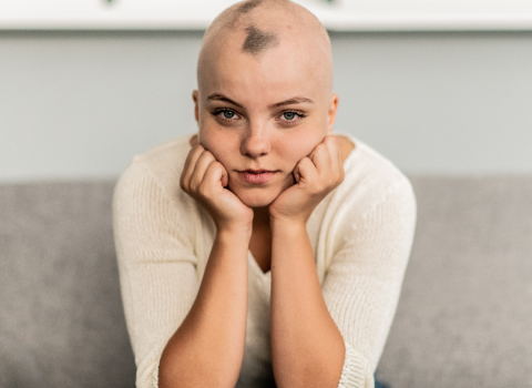 alopecija-kod-zena