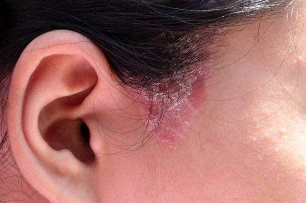 Erizipel-kožna bolest koju uzrokuje bakterija