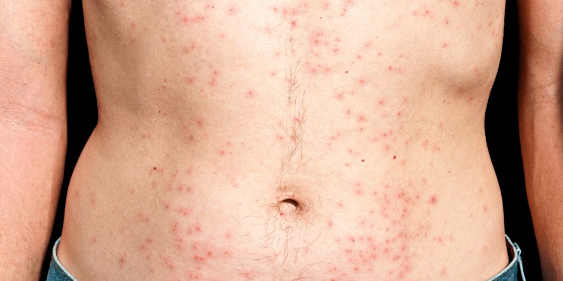 Svrbež kože tijela– uzroci i liječenje