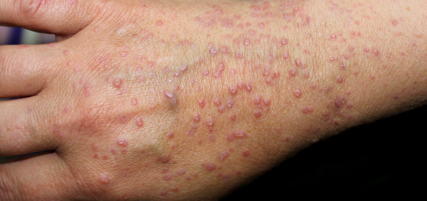 Lichen planus &#8211; uzroci, simptomi i liječenje