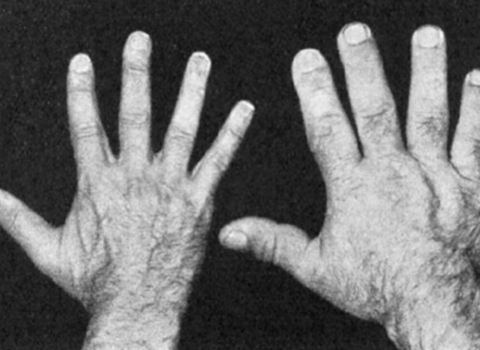 Slika prikazuje razliku u veličini ruku između zdrave ruke i akromegalije.
