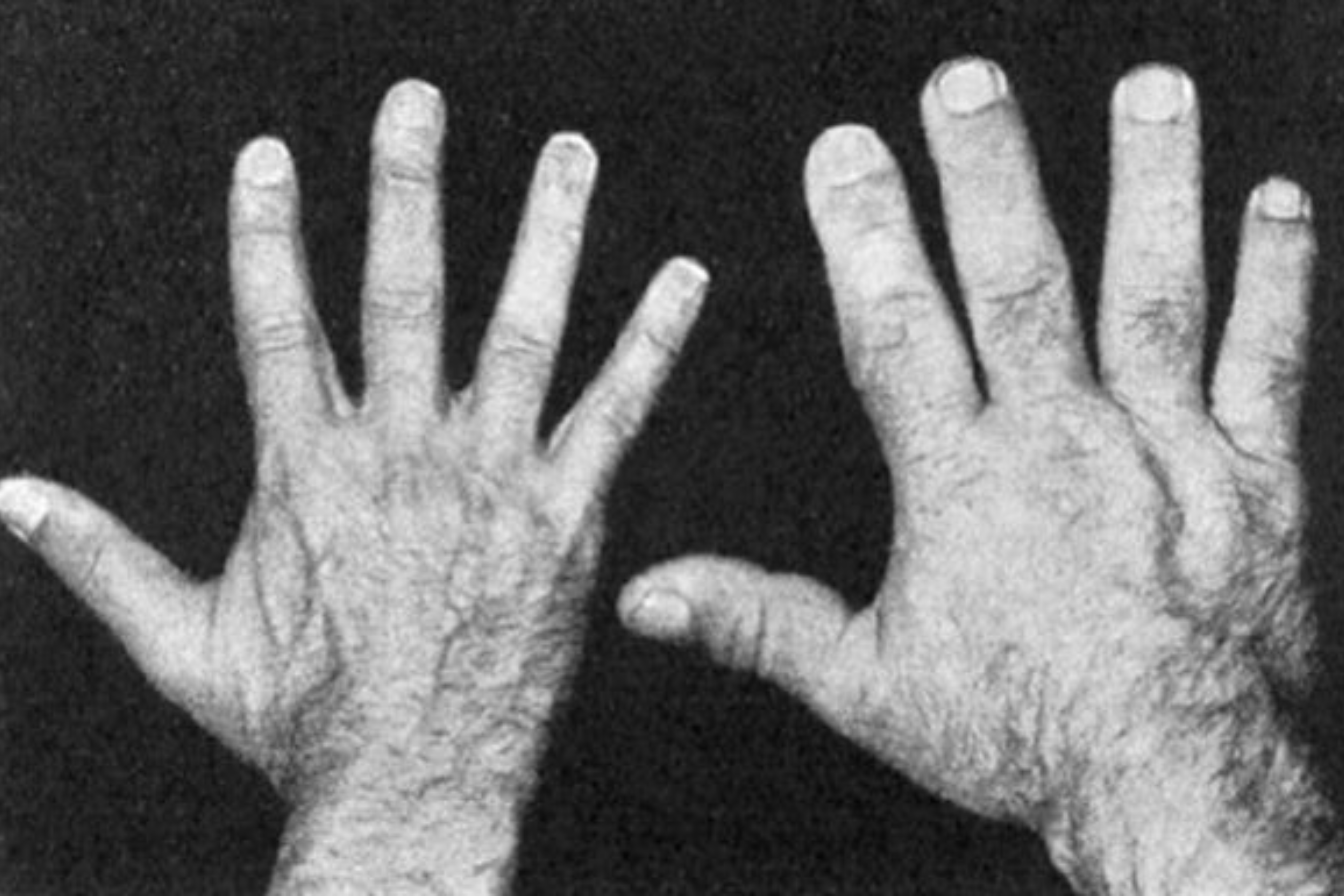 Slika prikazuje razliku u veličini ruku između zdrave ruke i akromegalije.