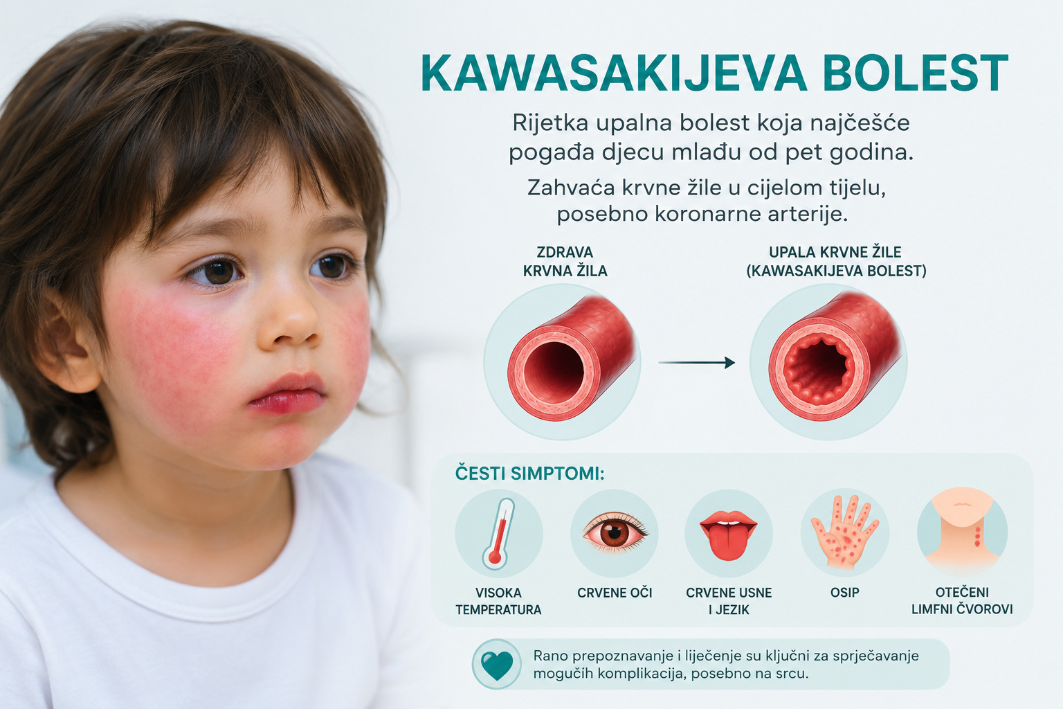 Kawasakijeva bolest